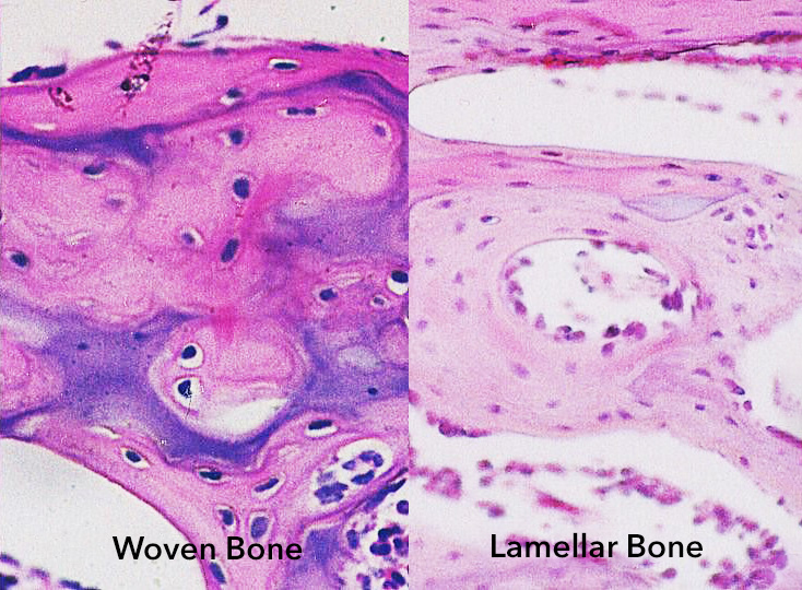 Side by side images of woven bone, which forms as the body attempts to repair a bone fracture, and lamellar bone, which is a mature, healthy bone.