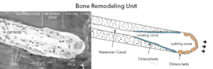 Cutting cone showing osteoclasts and osteblasts work during bone remodeling process.