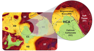 Histology image showing bone formation breaching the TrelCor HCA layer and entering calcium carbonate.